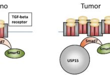 La desregulación del eje USP15-TGFß empeora el pronóstico en glioblastoma