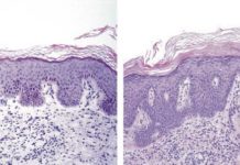 Potenciales vías terapéuticas para tratar la psoriasis con menor toxicidad