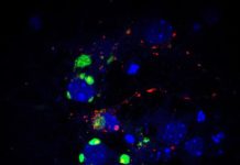 cúmuls de glicogen per als malalts de Lafora