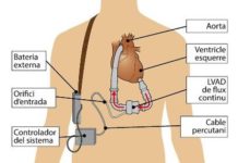 L’ús de les assistències ventriculars de llarga durada ha d’augmentar a Espanya