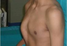 El Hospital de Bellvitge afianza la utilidad de la cirugía en casos de pectus carinatum