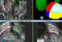 El mapeo prostático transperineal mejora el diagnóstico del cáncer de próstata