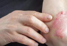 Uriage ofrece un decálogo para paliar la dermatitis atópica