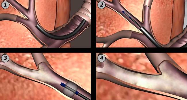 Nueva técnica de vapor de agua para tratar el enfisema pulmonar severo