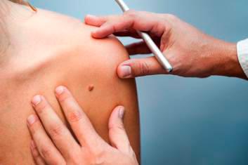 El CHMP recomienda autorizar cemiplimab para cáncer cutáneo de células escamosas avanzado