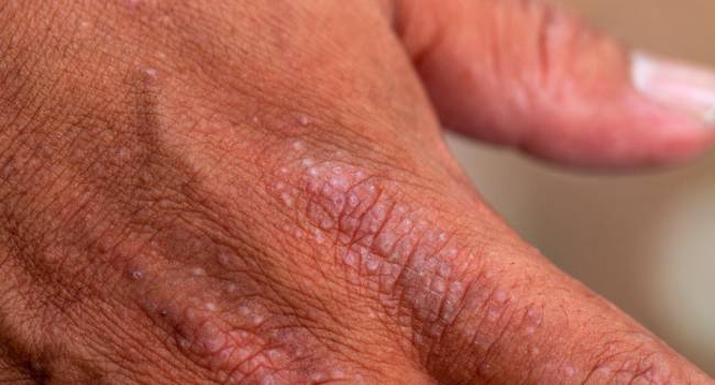 El 50% de los pacientes con dermatitis atópica padece episodios de depresión o ansiedad