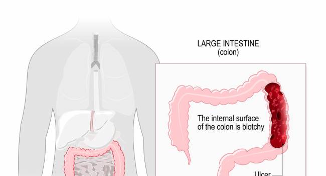 Eficacia del trasplante de heces para tratar la colitis ulcerosa