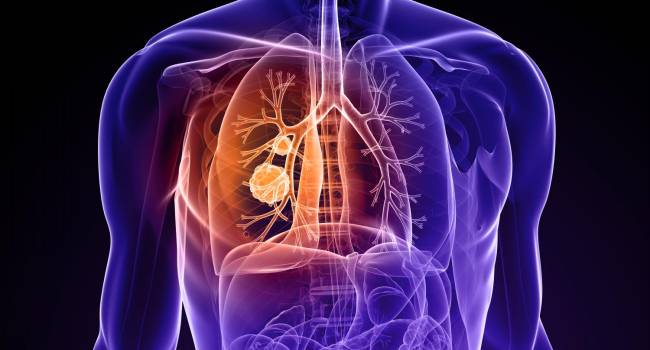 La FDA acepta la licencia biológica de Tecentriq más quimioterapia para cáncer de pulmón
