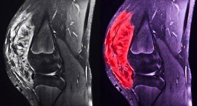 Vall d’Hebron impulsa el primer registro completo de pacientes con sarcoma