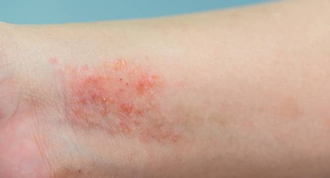 Expertos asocian la dermatitis atópica grave con posibles trastornos neuropsiquiátricos