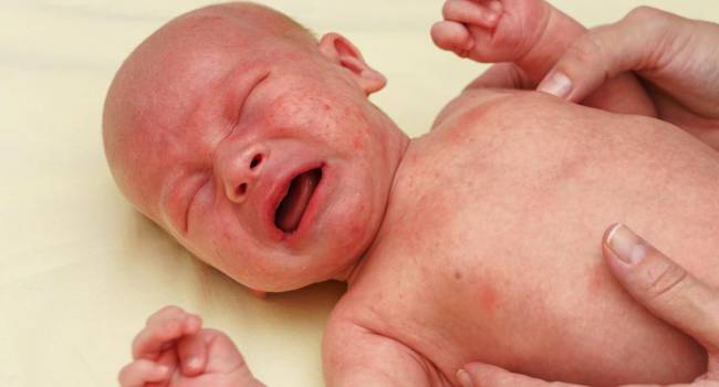 Entre el 6 y 15% de la población infantil sufre dermatitis atópica