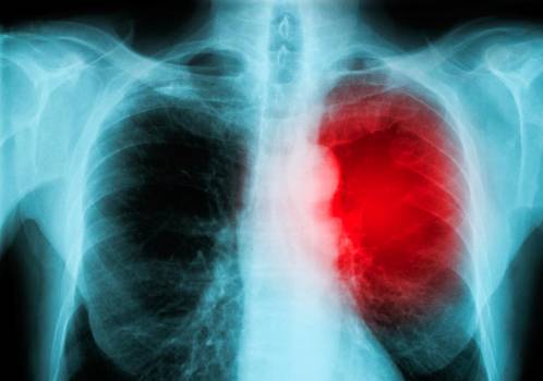 Tecentriq consigue la indicación de la FDA para cáncer de pulmón de células pequeñas