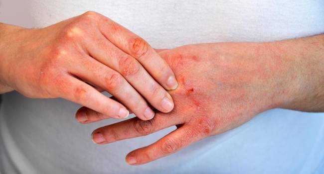 La necesidad de avanzar en dermatitis atópica grave