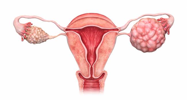 Las revisiones ginecológicas son fundamentales para incrementar el diagnóstico precoz del cáncer de ovario