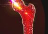 La remisión en artritis reumatoide reduce el riesgo de complicación cardiovascular