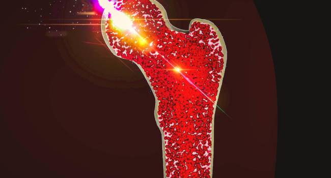 La remisión en artritis reumatoide reduce el riesgo de complicación cardiovascular