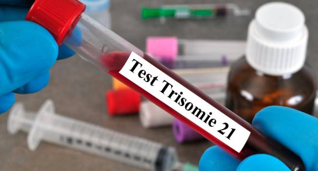 Un nuevo biosensor detectaría el síndrome de Down mediante análisis de sangre