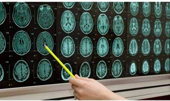 Nuevos datos refuerzan la eficacia de ocrelizumab en dos formas de EM