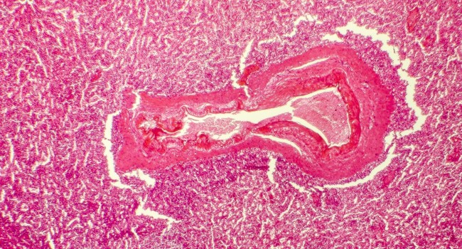 Descubren un cambio en el funcionamiento de los exosomas que puede ser clave en el abordaje de la diabetes tipo 2