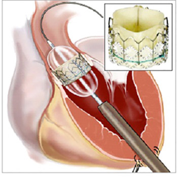 Las técnicas mínimamente invasivas han revolucionado la cirugía cardiovascular