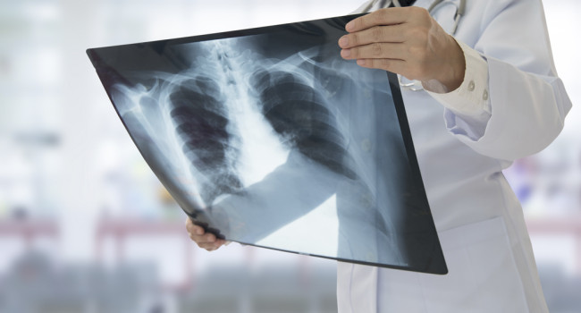Avances “alentadores” en ciertos casos de cáncer de pulmón en estado avanzado
