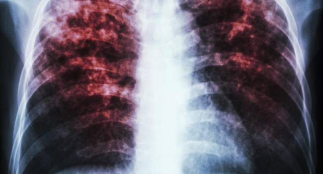 España, entre los países europeos que más casos de tuberculosis notifica
