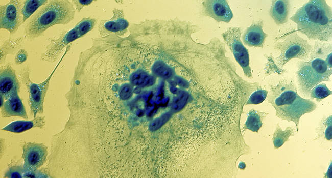 El cáncer de próstata: un viaje hacia las profundidades de la biología del tumor