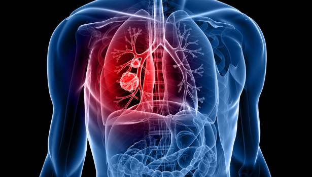 Roche presentará sus novedades en cáncer de pulmón en el WCLC