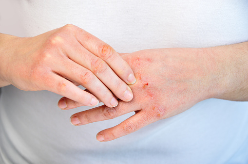 La campaña “Vivir Sin Vivir” refleja la realidad más desconocida de la dermatitis atópica