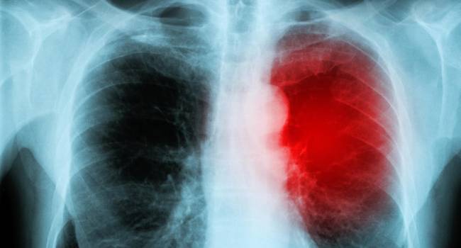 Optimizar la secuencia de tratamientos, clave en el abordaje del cáncer de pulmón