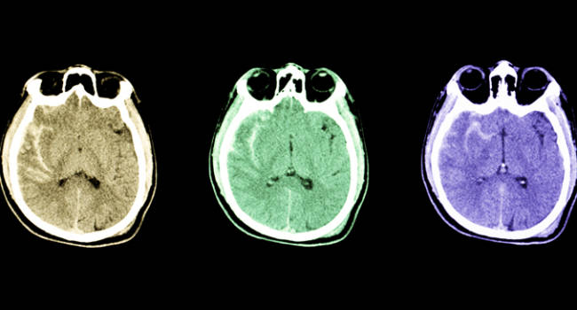 Brigatinib reduce el riesgo de progresión de metástasis cerebrales en CPNM avanzado ALK+
