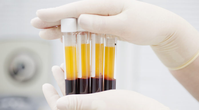 ¿Podría servir el plasma de los pacientes que superan el Covid-19 como antídoto?