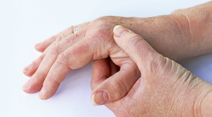 El SNS financia Cimzia, primer biológico para la psoriasis en placas de moderada a grave