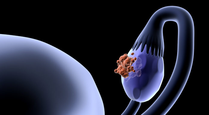 El CHMP recomienda aprobar Zejula en primera línea para cáncer de ovario avanzado
