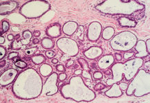El apoyo de la Estrategia de Ciencia a la I+D+i sanitaria, vital en cáncer de mama