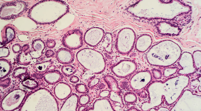 El apoyo de la Estrategia de Ciencia a la I+D+i sanitaria, vital en cáncer de mama