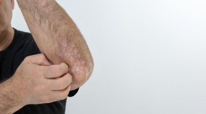 Francia financia el uso de Ilumetri para psoriasis grave en placas