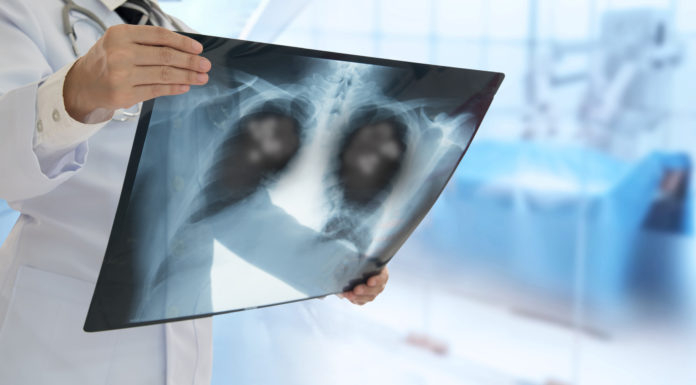 Los expertos abogan por promover la vacunación neumocócica en las medidas de prevención de la Salud Pública neumonia