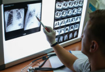 Un ensayo muestra que benralizumab elimina el uso de corticosteroides orales en pacientes con asma grave