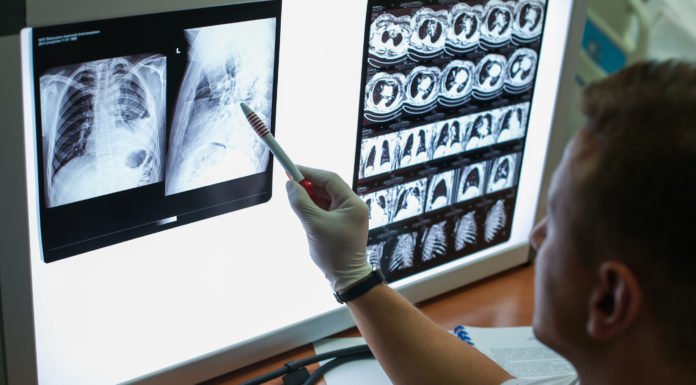 Un ensayo muestra que benralizumab elimina el uso de corticosteroides orales en pacientes con asma grave