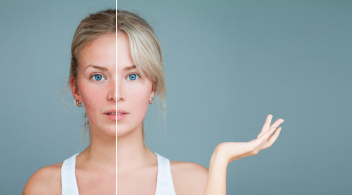 El Consejo General de Farmacéuticos difunde un protocolo para el abordaje de la rosácea rosacea
