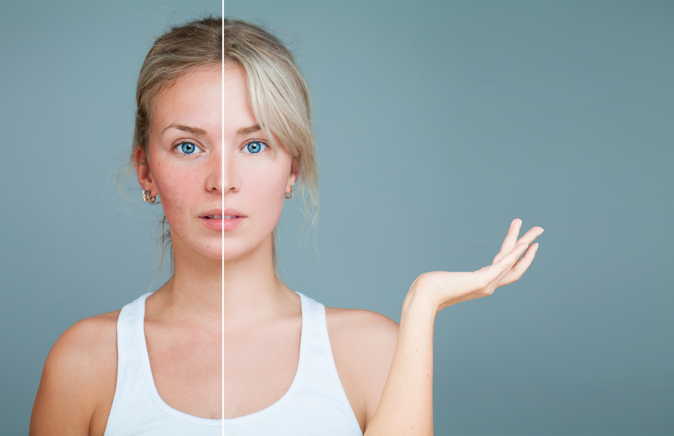 Young Woman with hand raised. Unhealthy and Healthy Skin After Treatment. Facial Treatment, Medicine and Cosmetology Concept. Perfect Skin and Skin Problem. rosacea