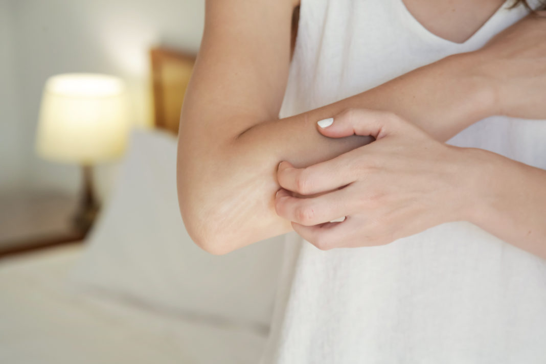 psoriasis